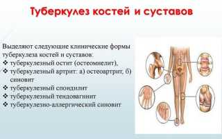 Что такое туберкулез костей и из за чего он происходит
