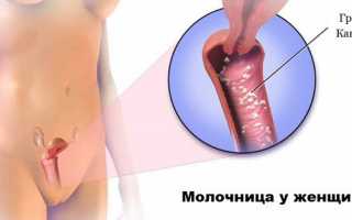 Последняя стадия молочницы у женщин